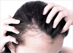 Hair Loss Treatment
